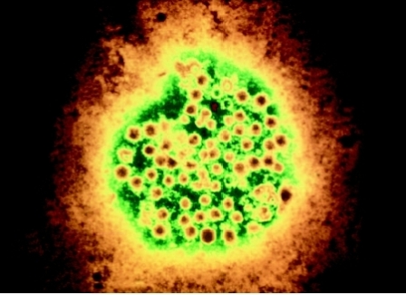 hepatitis_a.jpg